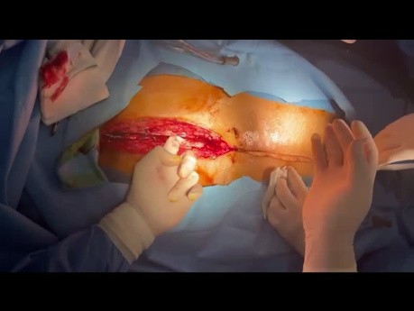 Organspende nach Koronararterien-Bypass-Transplantation