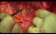 Zytoreduktive Chirurgie des Eierstockkrebses. Die modifizierte hintere Beckenexenteration.