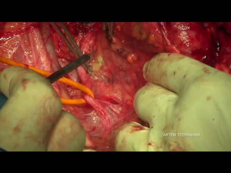 Zytoreduktive Chirurgie des Eierstockkrebses. Die modifizierte hintere Beckenexenteration.