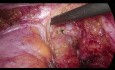 Rezidiv beim Rektumkarzinom - laparoskopische TME