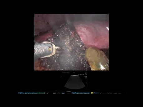 Roboterresektion eines hepatozellulären Karzinoms des Segments VI in einer Leberzirrhose mit intrakorporalem Pringle-Manöver