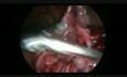 Laparoskopische Resektion des rießigen zystischen Ovarialteratoms in der Schwangerschaft