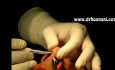 Offene Rhinoplastik