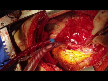 Beidseitiges Liposarkom der Pulmonalarterien