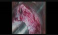 Totale laparoskopische Hysterektomie mit Morcellation 