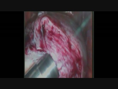 Totale laparoskopische Hysterektomie mit Morcellation 