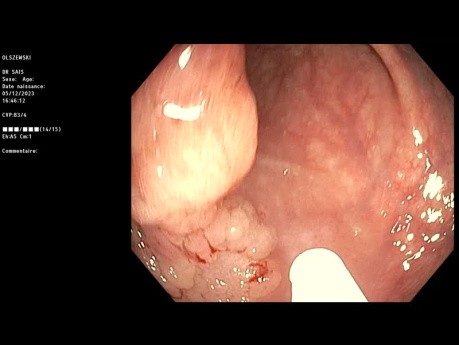 Kolonales laterales ausbreitendes Tumor durch EMR reseziert.