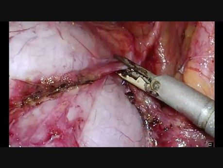 Całkowita laparoskopowa histerektomia związana z mięśniakiem zlokalizowanym w więzadle szerokim macicy