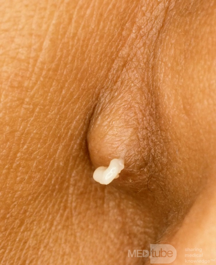 Epidermalzyste