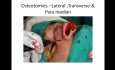 Verkleinerung des Nasenhöckers – eine Schritt-für-Schritt-Nasenkorrektur-Methode