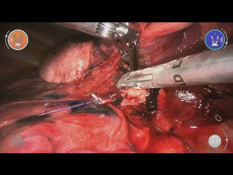 Right Lower Lobectomy with Versius - L Rosso