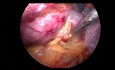 Dekortikation der Hilar-Nierenzyste durch retroperitoneale laparoskopische Chirurgie