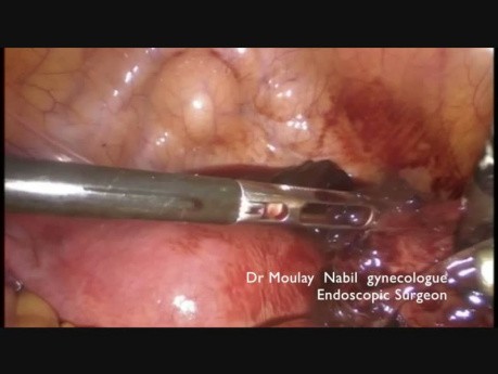Die laparoskopische Behandlung von der Extrauteringravidität- Tipps und Tricks
