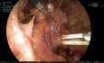 Axilloskopische Lymphknotendissektion: Ein technischer Leitfaden zur Navigation durch die komplexe neurovaskuläre Anatomie der Axilla