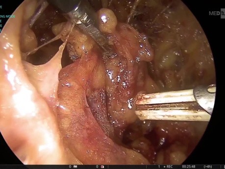 Axilloskopische Lymphknotendissektion: Ein technischer Leitfaden zur Navigation durch die komplexe neurovaskuläre Anatomie der Axilla