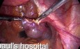 Salpingostomie zur Behandlung der Extrauteringravidität  (EUG)- laparoskopische Chirurgie