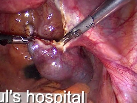 Salpingostomie zur Behandlung der Extrauteringravidität  (EUG)- laparoskopische Chirurgie