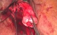 Vaginale Hysterektomie