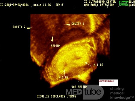 3D-Ultraschall von zwei Cervices