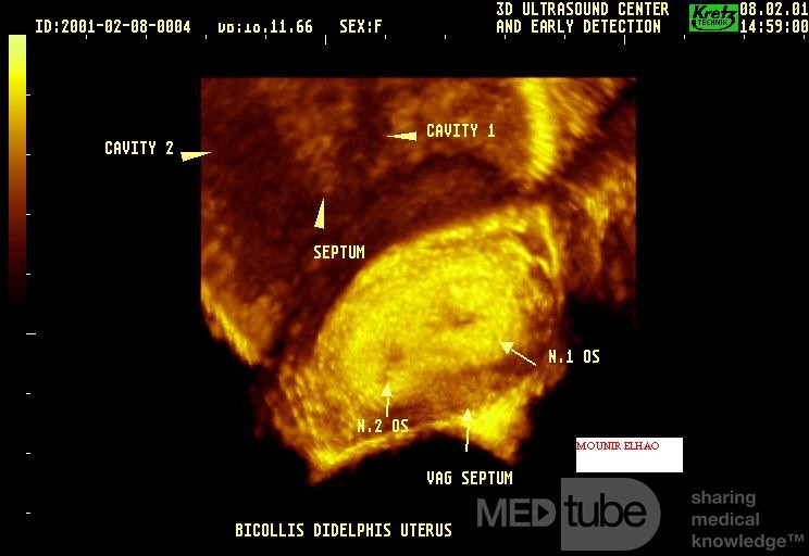 3D-Ultraschall von zwei Cervices