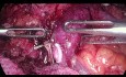 Laparoskopische totale Pankreasresektion bei einem Pankreaskopftumor