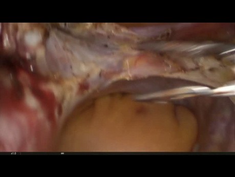 Subtotale Hysterektomie im Falle des großen Uterus (1340g)