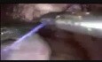Intrakorporale Naht bei der Laparoskopie - totale laparoskopische Hysterektomie