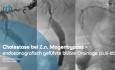 Endosonografisch-geführte biliäre Drainage (EUS-BD) bei Z.n. Magenbypass-OP