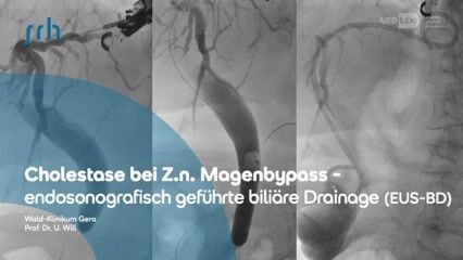 Endosonografisch-geführte biliäre Drainage (EUS-BD) bei Z.n. Magenbypass-OP