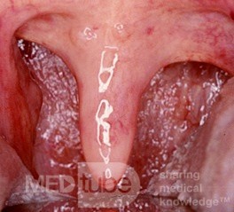 Verlängerte Uvula