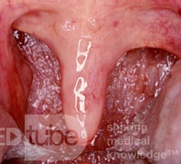 Verlängerte Uvula