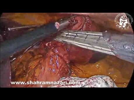 Laparoskopische Resektion eines riesigen gastrointestinalen Stromatumors (GIST) des Magens der kleineren Kurvatur mittels Gastrostomie