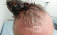 Angiosarkom der Kopfhaut