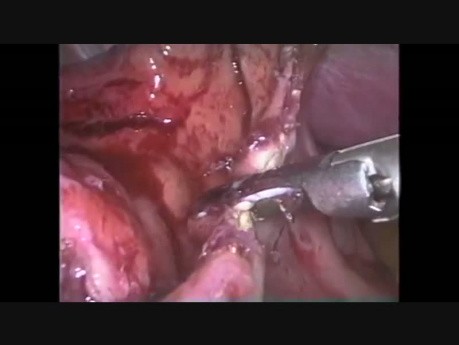 Laparoskopische Behandlung von Ösophagusperforationen nach Endoskopie