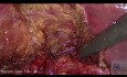 Entzündung und Dilatation des Ductus cholezysticus aufgrund einer chronischen kalkulösen Cholezystitis