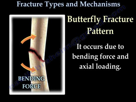 Frakturen - Einteilung und Pathomechanismus