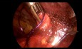 Reparatur eines gerissenen Peritoneums während einer TEP-Operation