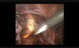 Laparoskopische Hysterektomie mit einem beleuchteten Uterus-Manipulator
