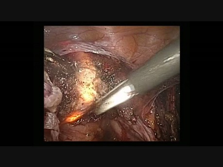Laparoskopische Hysterektomie mit einem beleuchteten Uterus-Manipulator