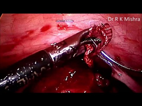 Zervixcerclage