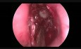 Endoskopische transnasale Resektion des Osteoms des Sinus frontalis