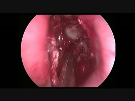 Endoskopische transnasale Resektion des Osteoms des Sinus frontalis