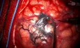 Rechtsseitige Kraniotomie und Resektion einer arteriovenösen Malformation (AVM)