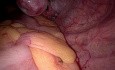 Salpingektomie mit SILS-Port für Eileiterschwangerschaft