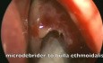Funktionelle endoskopische Nasennebenhöhlenoperation - Siebbeinmukozele