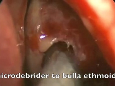 Funktionelle endoskopische Nasennebenhöhlenoperation - Siebbeinmukozele