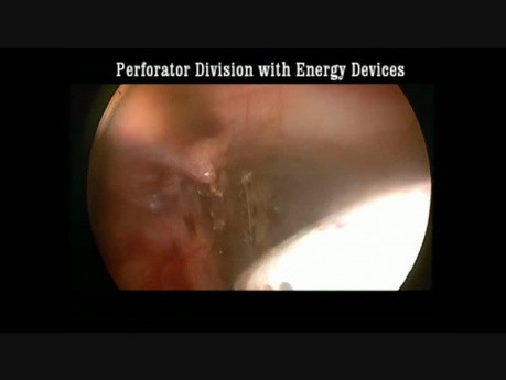 Endoskopische subfasziale Perforansdissektion (ESDP)