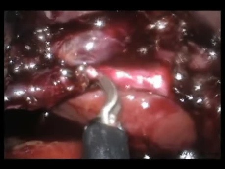 Laparo-endoskopische Einzelschnitt-Cholezystektomie (LESS) mit intraoperativem Cholangiogramm.