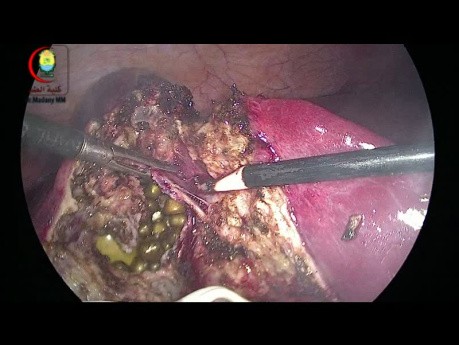 Gallenblasenriss während der laparoskopischen Cholezystektomie