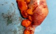 Laparoskopische Entfernung von Appendix-Neoplasmen